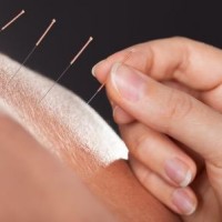 Akupunktur som supplement